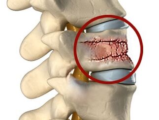 Ο πόνος στην πλάτη μπορεί να προκληθεί από ασθένειες της σπονδυλικής στήλης και των μεσοσπονδύλιων δίσκων. 