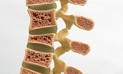 Η οστεοπόρωση είναι μια από τις αιτίες του πόνου στη μέση